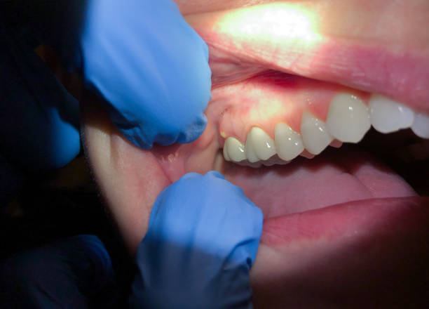 Best Same-Day Emergency Dental Services in Moundville, AL